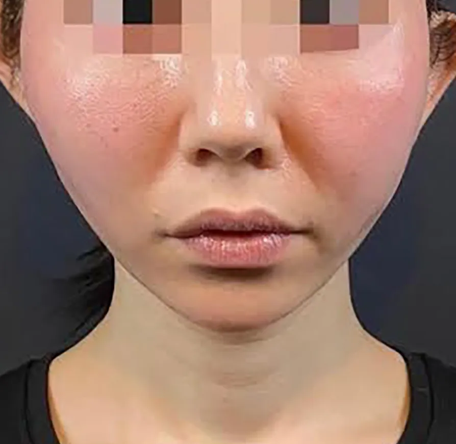 Combination Lift (HIFU + Thread) After