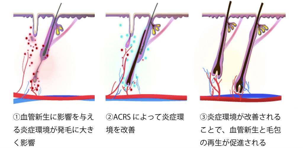 ACRS ヘア